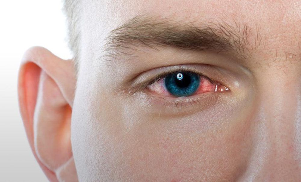 Chăm sóc mắt để ngăn chặn nhiễm trùng