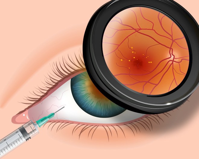 Bệnh mắt nguy hiểm: thoái hóa điểm vàng 